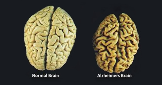 Desktop ths aug28 part1 08 contributor  the 3 vitamins that prevent brain loss